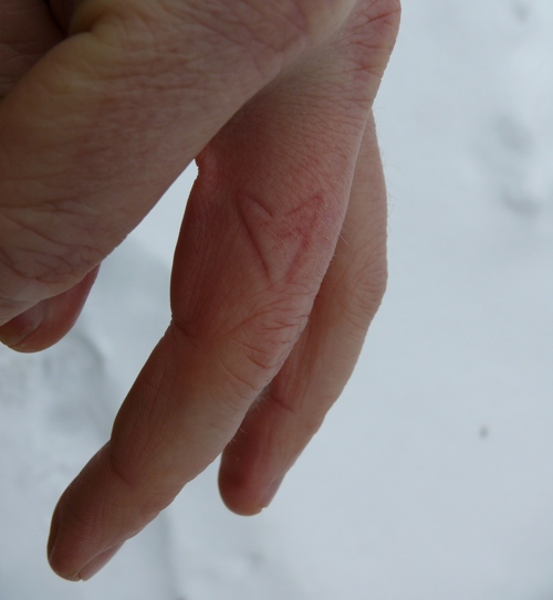 Finger with a Northern Cardinal bite mark